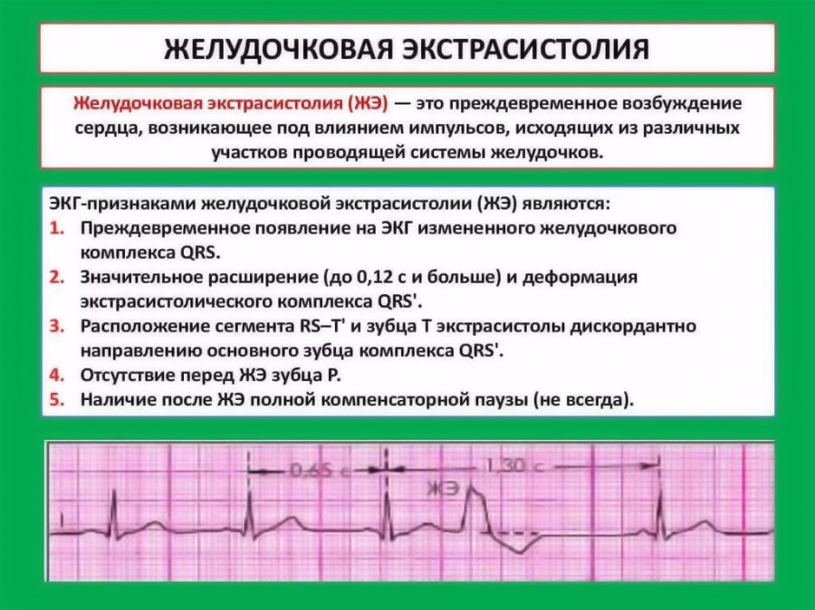 Экстрасистолия